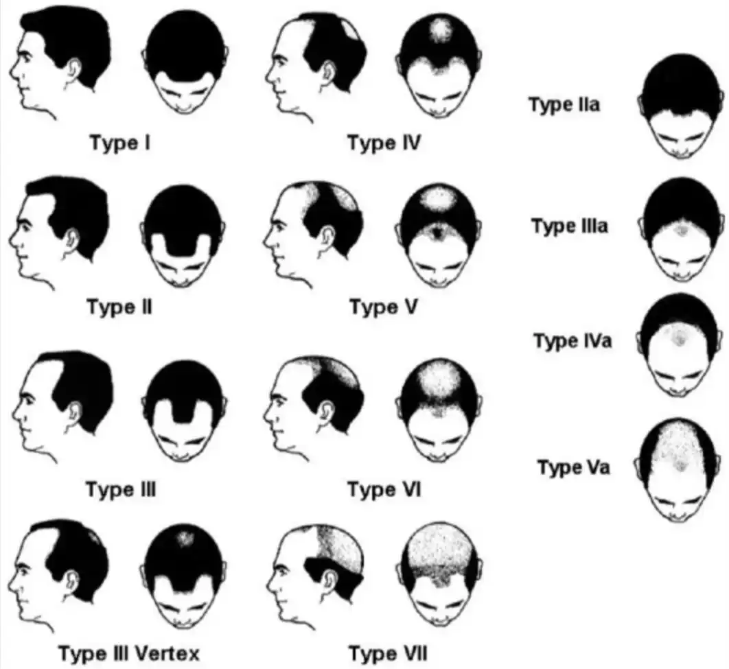 norwood scale
