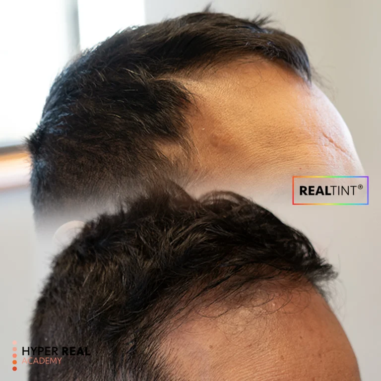 Hyper Real Academy SMP training demonstration showing RealTint scalp micropigmentation on a receding hairline.