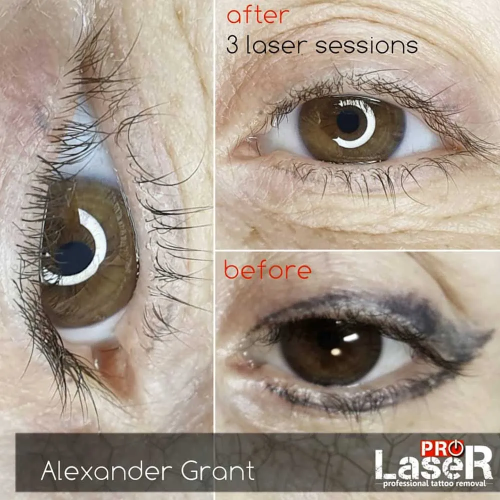 Before and after nano brows transformation. Top: natural sparse light brows. Bottom: dark, full brows with defined arch and hair-like strokes. RealTint pigment, Hyper Real Academy technique showing microblading or nano brows PMU results.