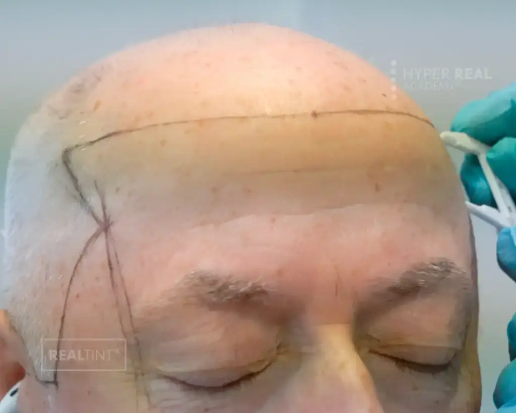 SMP (Scalp Micropigmentation) procedure in progress. Technician in pink gloves stretching client's scalp skin taut while using rotary tattoo machine for follicle simulation. Tiny black micro-dots visible on scalp, creating hair stubble illusion. PMU density enhancement technique.