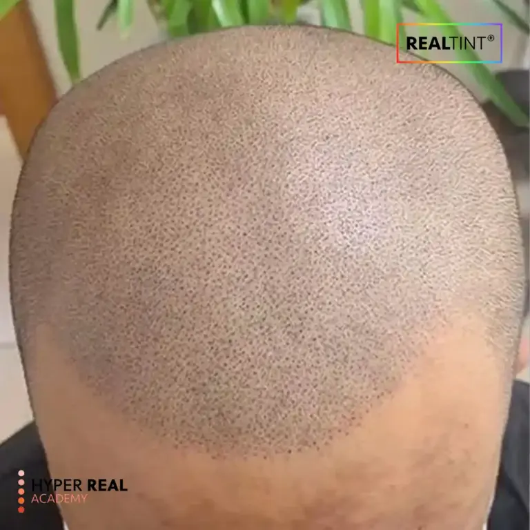 SMP hairline restoration - close-up of side profile showing stippled dotted hairline transition from scalp to forehead. Buzz cut style created through cosmetic tattooing.