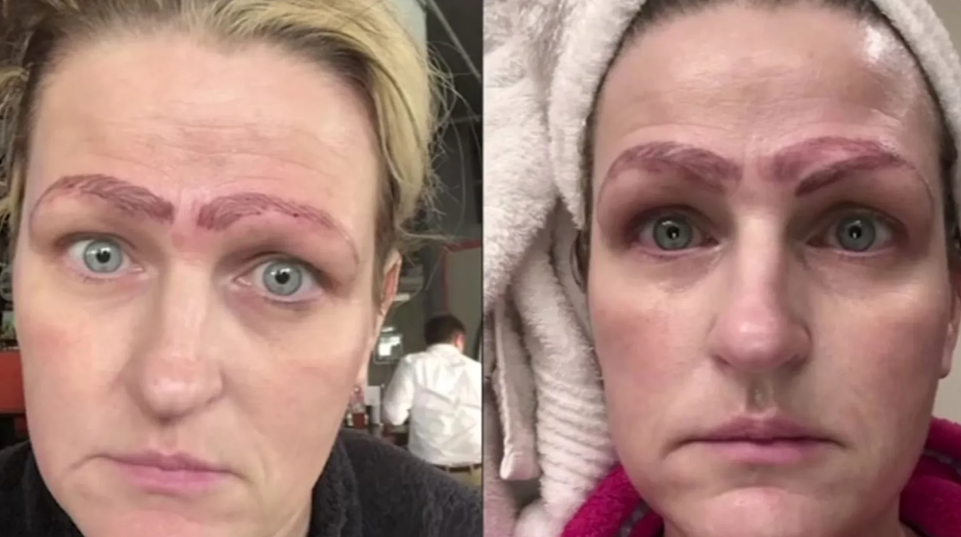 misaligned eyebrows on a client face