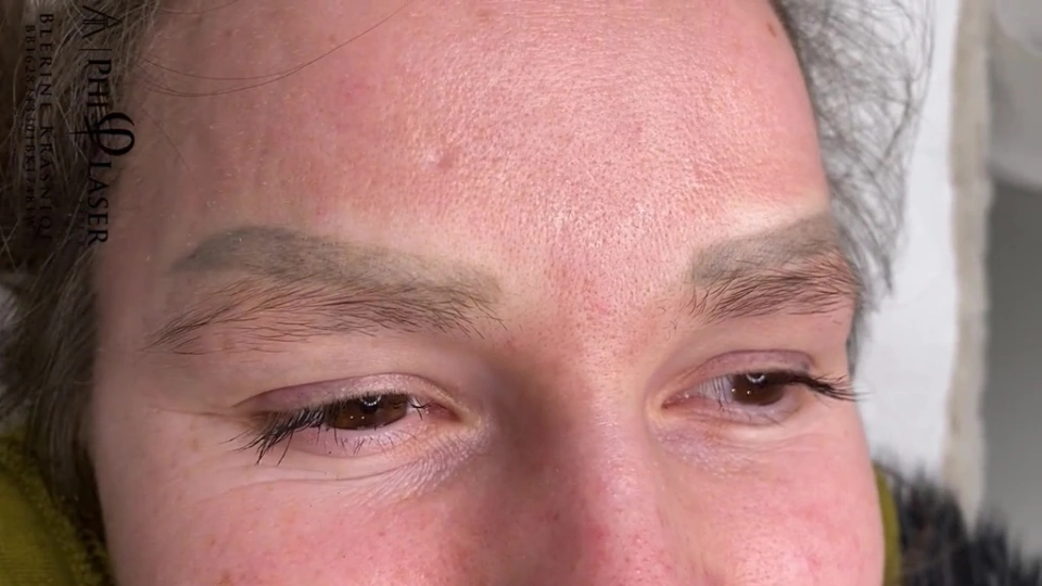 moderate to severe misalignment of brow PMU