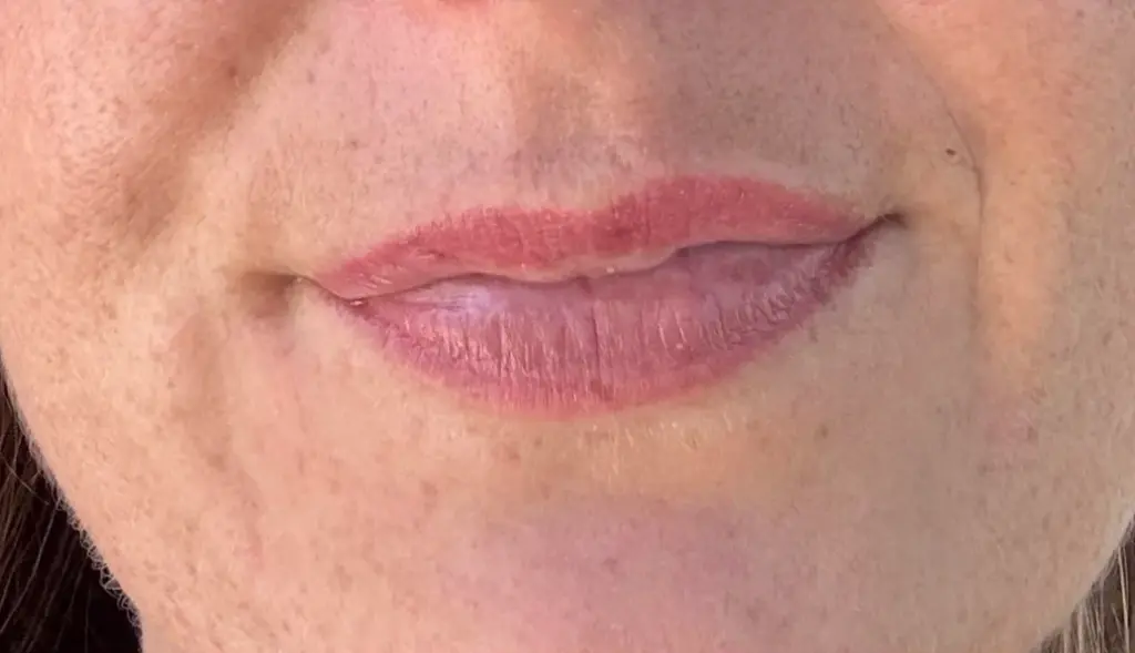 patchy healing on lips